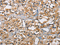 The image on the left is immunohistochemistry of paraffin-embedded Human thyroid cancer tissue using CSB-PA916143(PPP3CA Antibody) at dilution 1/30, on the right is treated with fusion protein. (Original magnification: ×200)