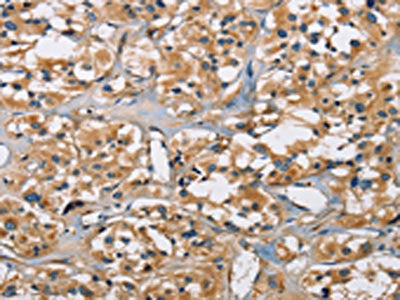 The image on the left is immunohistochemistry of paraffin-embedded Human thyroid cancer tissue using CSB-PA916143(PPP3CA Antibody) at dilution 1/30, on the right is treated with fusion protein. (Original magnification: ×200)