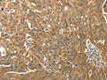 The image on the left is immunohistochemistry of paraffin-embedded Human ovarian cancer tissue using CSB-PA916321(RARA Antibody) at dilution 1/40, on the right is treated with fusion protein. (Original magnification: ×200)