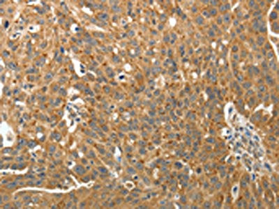 The image on the left is immunohistochemistry of paraffin-embedded Human ovarian cancer tissue using CSB-PA916321(RARA Antibody) at dilution 1/40, on the right is treated with fusion protein. (Original magnification: ×200)