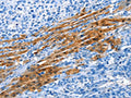 The image on the left is immunohistochemistry of paraffin-embedded Human liver cancer tissue using CSB-PA916372(ADH4 Antibody) at dilution 1/35, on the right is treated with fusion protein. (Original magnification: ×200)