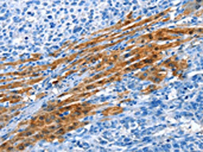 The image on the left is immunohistochemistry of paraffin-embedded Human liver cancer tissue using CSB-PA916372(ADH4 Antibody) at dilution 1/35, on the right is treated with fusion protein. (Original magnification: ×200)