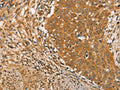 The image on the left is immunohistochemistry of paraffin-embedded Human cervical cancer tissue using CSB-PA916723(ARMCX3 Antibody) at dilution 1/40, on the right is treated with fusion protein. (Original magnification: ×200)