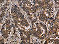 The image on the left is immunohistochemistry of paraffin-embedded Human liver cancer tissue using CSB-PA916967(FMR1 Antibody) at dilution 1/30, on the right is treated with fusion protein. (Original magnification: ×200)