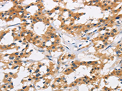 The image is immunohistochemistry of paraffin-embedded Human thyroid cancer tissue using CSB-PA917071(AXIN2 Antibody) at dilution 1/20. (Original magnification: ×200)