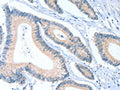 The image on the left is immunohistochemistry of paraffin-embedded Human colon cancer tissue using CSB-PA917188(ACTL7B Antibody) at dilution 1/20, on the right is treated with fusion protein. (Original magnification: ×200)