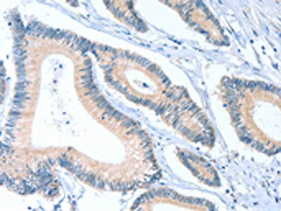 The image on the left is immunohistochemistry of paraffin-embedded Human colon cancer tissue using CSB-PA917188(ACTL7B Antibody) at dilution 1/20, on the right is treated with fusion protein. (Original magnification: ×200)