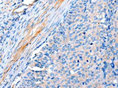 The image on the left is immunohistochemistry of paraffin-embedded Human cervical cancer tissue using CSB-PA917287(ACTRT1 Antibody) at dilution 1/15, on the right is treated with fusion protein. (Original magnification: ×200)