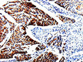 The image is immunohistochemistry of paraffin-embedded Human cervical cancer tissue using CSB-PA917452(TUBB3 Antibody) at dilution 1/25. (Original magnification: ×200)
