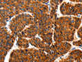 The image on the left is immunohistochemistry of paraffin-embedded Human liver cancer tissue using CSB-PA917523(TRAP1 Antibody) at dilution 1/100, on the right is treated with fusion protein. (Original magnification: ×200)