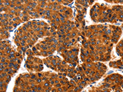 The image on the left is immunohistochemistry of paraffin-embedded Human liver cancer tissue using CSB-PA917523(TRAP1 Antibody) at dilution 1/100, on the right is treated with fusion protein. (Original magnification: ×200)