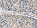 The image on the left is immunohistochemistry of paraffin-embedded Human esophagus cancer tissue using CSB-PA917997(TPH2 Antibody) at dilution 1/20, on the right is treated with synthetic peptide. (Original magnification: ×200)