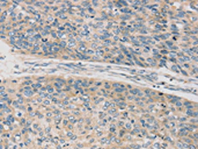 The image on the left is immunohistochemistry of paraffin-embedded Human esophagus cancer tissue using CSB-PA917997(TPH2 Antibody) at dilution 1/20, on the right is treated with synthetic peptide. (Original magnification: ×200)