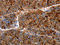 The image on the left is immunohistochemistry of paraffin-embedded Human liver cancer tissue using CSB-PA918257(AKR1B10 Antibody) at dilution 1/30, on the right is treated with fusion protein. (Original magnification: ×200)