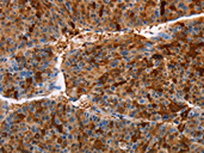 The image on the left is immunohistochemistry of paraffin-embedded Human liver cancer tissue using CSB-PA918257(AKR1B10 Antibody) at dilution 1/30, on the right is treated with fusion protein. (Original magnification: ×200)
