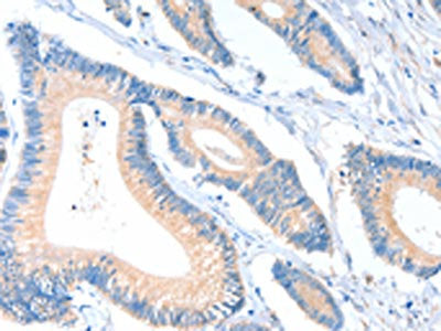 The image on the left is immunohistochemistry of paraffin-embedded Human colon cancer tissue using CSB-PA918458(ACTR1A Antibody) at dilution 1/10, on the right is treated with fusion protein. (Original magnification: ×200)