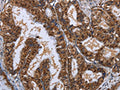 The image on the left is immunohistochemistry of paraffin-embedded Human esophagus cancer tissue using CSB-PA918865(LTA4H Antibody) at dilution 1/30, on the right is treated with fusion protein. (Original magnification: ×200)