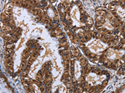 The image on the left is immunohistochemistry of paraffin-embedded Human esophagus cancer tissue using CSB-PA918865(LTA4H Antibody) at dilution 1/30, on the right is treated with fusion protein. (Original magnification: ×200)