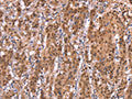 The image on the left is immunohistochemistry of paraffin-embedded Human gastic cancer tissue using CSB-PA918886(AMER1 Antibody) at dilution 1/40, on the right is treated with synthetic peptide. (Original magnification: ×200)