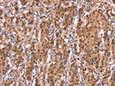 The image on the left is immunohistochemistry of paraffin-embedded Human gastic cancer tissue using CSB-PA918886(AMER1 Antibody) at dilution 1/40, on the right is treated with synthetic peptide. (Original magnification: ×200)