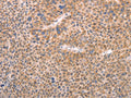 The image on the left is immunohistochemistry of paraffin-embedded Human liver cancer tissue using CSB-PA919003(AASDHPPT Antibody) at dilution 1/30, on the right is treated with fusion protein. (Original magnification: ×200)