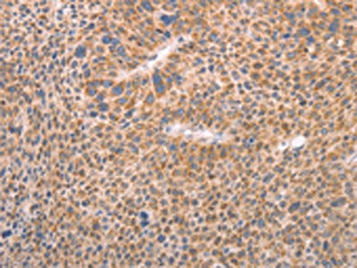 The image on the left is immunohistochemistry of paraffin-embedded Human liver cancer tissue using CSB-PA919003(AASDHPPT Antibody) at dilution 1/30, on the right is treated with fusion protein. (Original magnification: ×200)