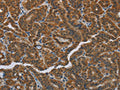 The image on the left is immunohistochemistry of paraffin-embedded Human thyroid cancer tissue using CSB-PA919270(HSD3B7 Antibody) at dilution 1/40, on the right is treated with fusion protein. (Original magnification: ×200)