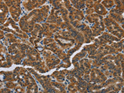 The image on the left is immunohistochemistry of paraffin-embedded Human thyroid cancer tissue using CSB-PA919270(HSD3B7 Antibody) at dilution 1/40, on the right is treated with fusion protein. (Original magnification: ×200)