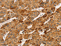The image on the left is immunohistochemistry of paraffin-embedded Human liver cancer tissue using CSB-PA919361(LTB Antibody) at dilution 1/45, on the right is treated with synthetic peptide. (Original magnification: ×200)