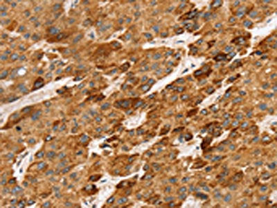 The image on the left is immunohistochemistry of paraffin-embedded Human liver cancer tissue using CSB-PA919361(LTB Antibody) at dilution 1/45, on the right is treated with synthetic peptide. (Original magnification: ×200)