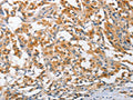 The image on the left is immunohistochemistry of paraffin-embedded Human thyroid cancer tissue using CSB-PA919511(ARL8A Antibody) at dilution 1/25, on the right is treated with fusion protein. (Original magnification: ×200)
