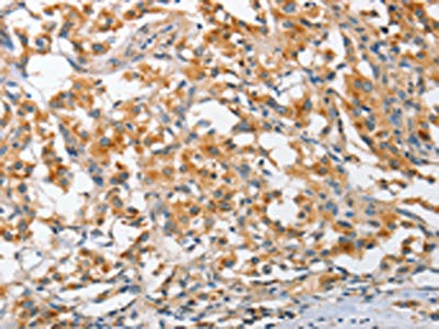 The image on the left is immunohistochemistry of paraffin-embedded Human thyroid cancer tissue using CSB-PA919511(ARL8A Antibody) at dilution 1/25, on the right is treated with fusion protein. (Original magnification: ×200)