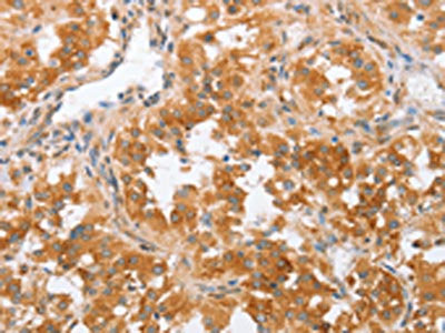 The image on the left is immunohistochemistry of paraffin-embedded Human thyroid cancer tissue using CSB-PA919659(CRELD2 Antibody) at dilution 1/50, on the right is treated with fusion protein. (Original magnification: ×200)