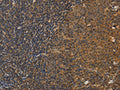 The image on the left is immunohistochemistry of paraffin-embedded Human tonsil tissue using CSB-PA919681(DCTN5 Antibody) at dilution 1/25, on the right is treated with fusion protein. (Original magnification: ×200)