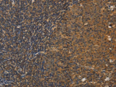The image on the left is immunohistochemistry of paraffin-embedded Human tonsil tissue using CSB-PA919681(DCTN5 Antibody) at dilution 1/25, on the right is treated with fusion protein. (Original magnification: ×200)