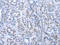 The image on the left is immunohistochemistry of paraffin-embedded Human thyroid cancer tissue using CSB-PA919764(PAX8 Antibody) at dilution 1/35, on the right is treated with fusion protein. (Original magnification: ×200)