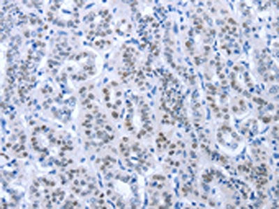 The image on the left is immunohistochemistry of paraffin-embedded Human thyroid cancer tissue using CSB-PA919764(PAX8 Antibody) at dilution 1/35, on the right is treated with fusion protein. (Original magnification: ×200)
