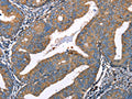 The image on the left is immunohistochemistry of paraffin-embedded Human cervical cancer tissue using CSB-PA919793(DEFA1 Antibody) at dilution 1/10, on the right is treated with fusion protein. (Original magnification: ×200)