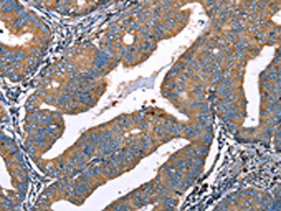The image on the left is immunohistochemistry of paraffin-embedded Human cervical cancer tissue using CSB-PA919793(DEFA1 Antibody) at dilution 1/10, on the right is treated with fusion protein. (Original magnification: ×200)