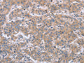 The image on the left is immunohistochemistry of paraffin-embedded Human liver cancer tissue using CSB-PA920250(ECE1 Antibody) at dilution 1/30, on the right is treated with fusion protein. (Original magnification: ×200)