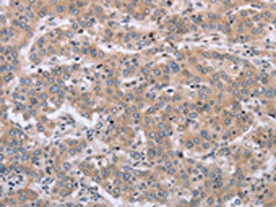 The image on the left is immunohistochemistry of paraffin-embedded Human liver cancer tissue using CSB-PA920250(ECE1 Antibody) at dilution 1/30, on the right is treated with fusion protein. (Original magnification: ×200)