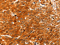 The image on the left is immunohistochemistry of paraffin-embedded Human esophagus cancer tissue using CSB-PA920298(SERPINB5 Antibody) at dilution 1/60, on the right is treated with fusion protein. (Original magnification: ×200)