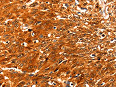 The image on the left is immunohistochemistry of paraffin-embedded Human esophagus cancer tissue using CSB-PA920298(SERPINB5 Antibody) at dilution 1/60, on the right is treated with fusion protein. (Original magnification: ×200)