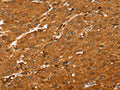 The image on the left is immunohistochemistry of paraffin-embedded Human liver cancer tissue using CSB-PA920347(ABCC9 Antibody) at dilution 1/35, on the right is treated with synthetic peptide. (Original magnification: ×200)