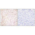 Immunohistochemical analysis of paraffin-embedded human breast carcinoma tissue using Stefin B antibody.
