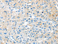 The image on the left is immunohistochemistry of paraffin-embedded Human liver cancer tissue using CSB-PA920694(TNFSF4 Antibody) at dilution 1/20, on the right is treated with synthetic peptide. (Original magnification: ×200)