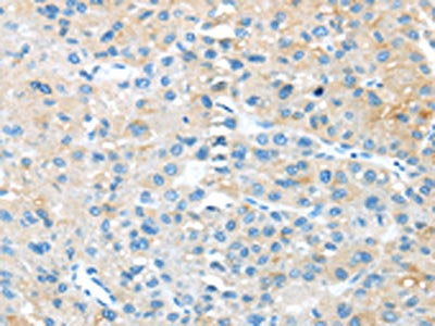 The image on the left is immunohistochemistry of paraffin-embedded Human liver cancer tissue using CSB-PA920694(TNFSF4 Antibody) at dilution 1/20, on the right is treated with synthetic peptide. (Original magnification: ×200)