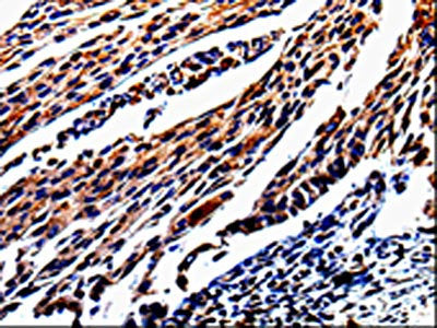 The image is immunohistochemistry of paraffin-embedded Human cervical cancer tissue using CSB-PA920807(KLK3 Antibody) at dilution 1/25. (Original magnification: ×200)