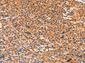 The image on the left is immunohistochemistry of paraffin-embedded Human liver cancer tissue using CSB-PA920990(AMPD1 Antibody) at dilution 1/80, on the right is treated with synthetic peptide. (Original magnification: ×200)