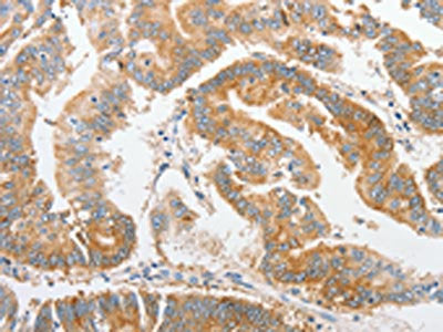 The image on the left is immunohistochemistry of paraffin-embedded Human colon cancer tissue using CSB-PA921124(ALPI Antibody) at dilution 1/25, on the right is treated with fusion protein. (Original magnification: ×200)